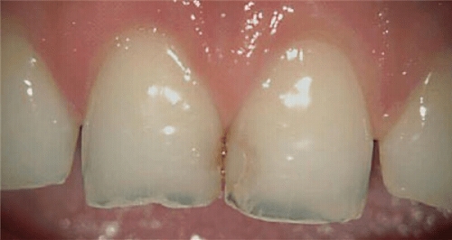 歯間の虫歯