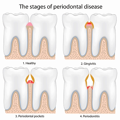 歯周病の段階